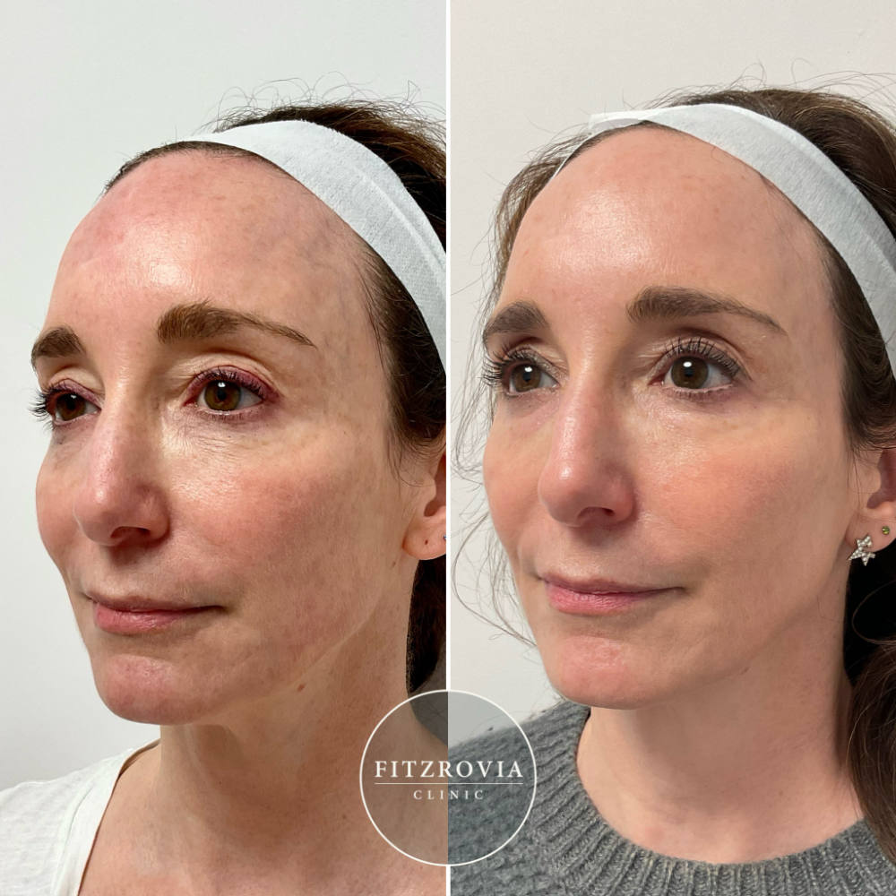 LaseMD Ultra Before and After Melasma 1