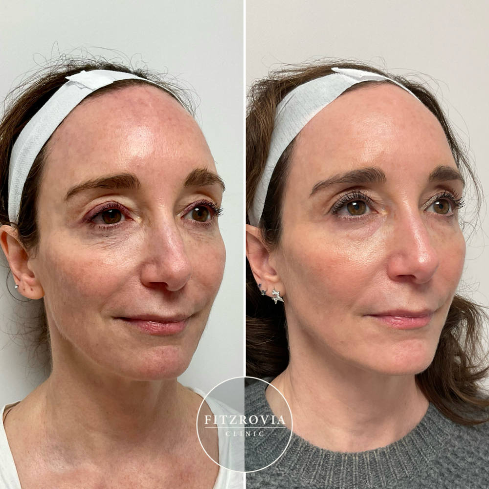 LaseMD Ultra Before and After Melasma