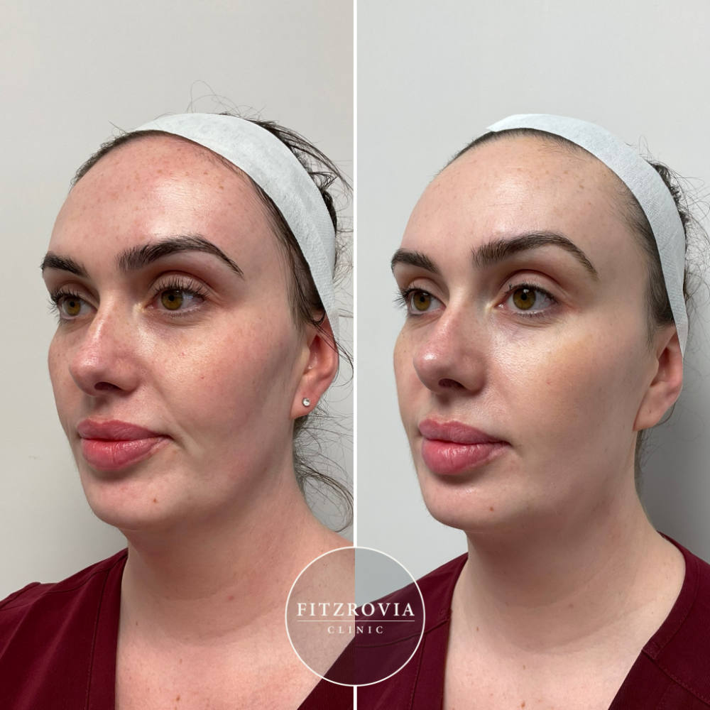 LaseMD Ultra Before and After Pigmentation 1