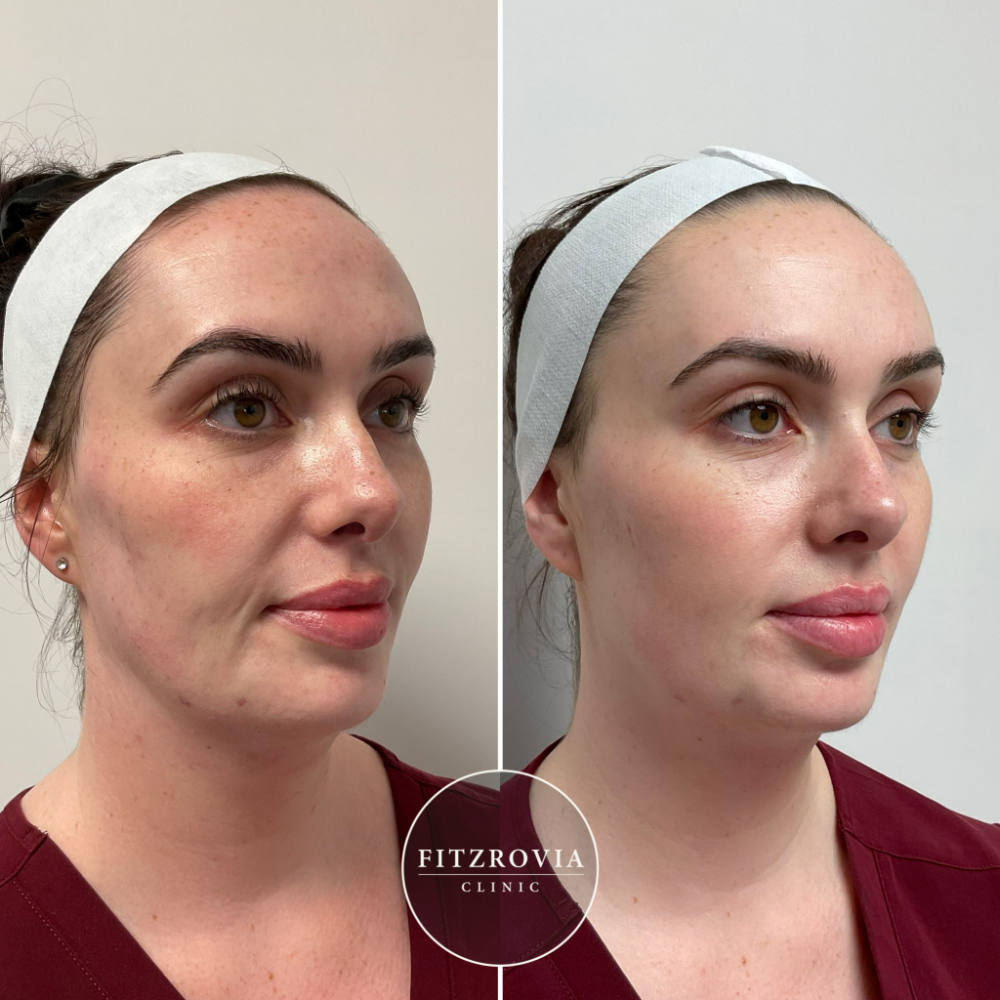 LaseMD Ultra Before and After Pigmentation